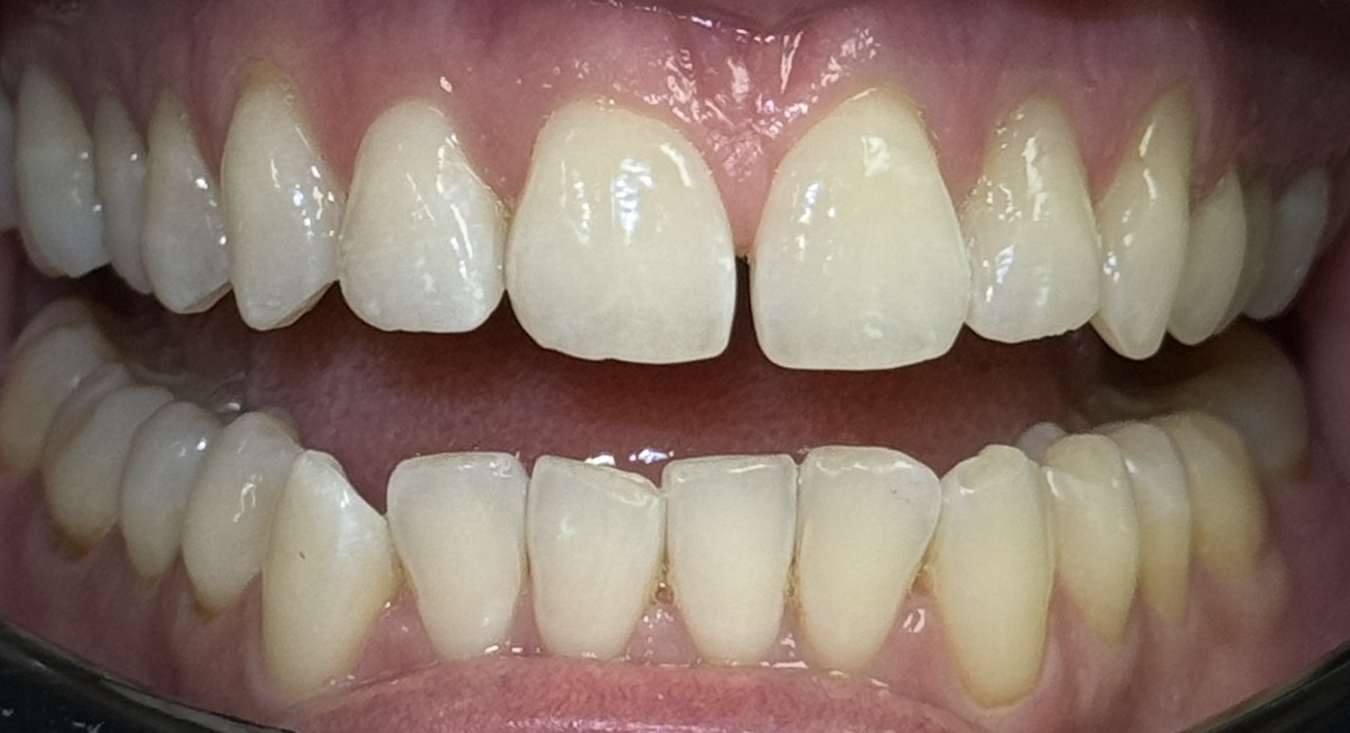 Close-up of Anhelina's teeth before Invisalign