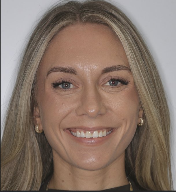 Before Smile Sculpt — patient smile prior to prepless hybrid veneer treatment at Boesch Dental Orlando