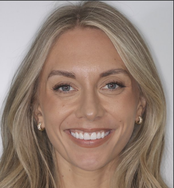 After Smile Sculpt — beautiful natural-looking hybrid veneer result by Dr. Boesch, Orlando