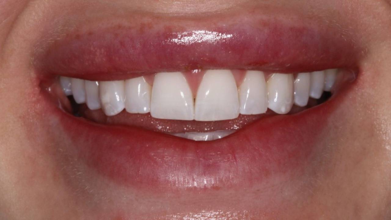 Before Smile Sculpt — flat, worn, short teeth with uneven edges