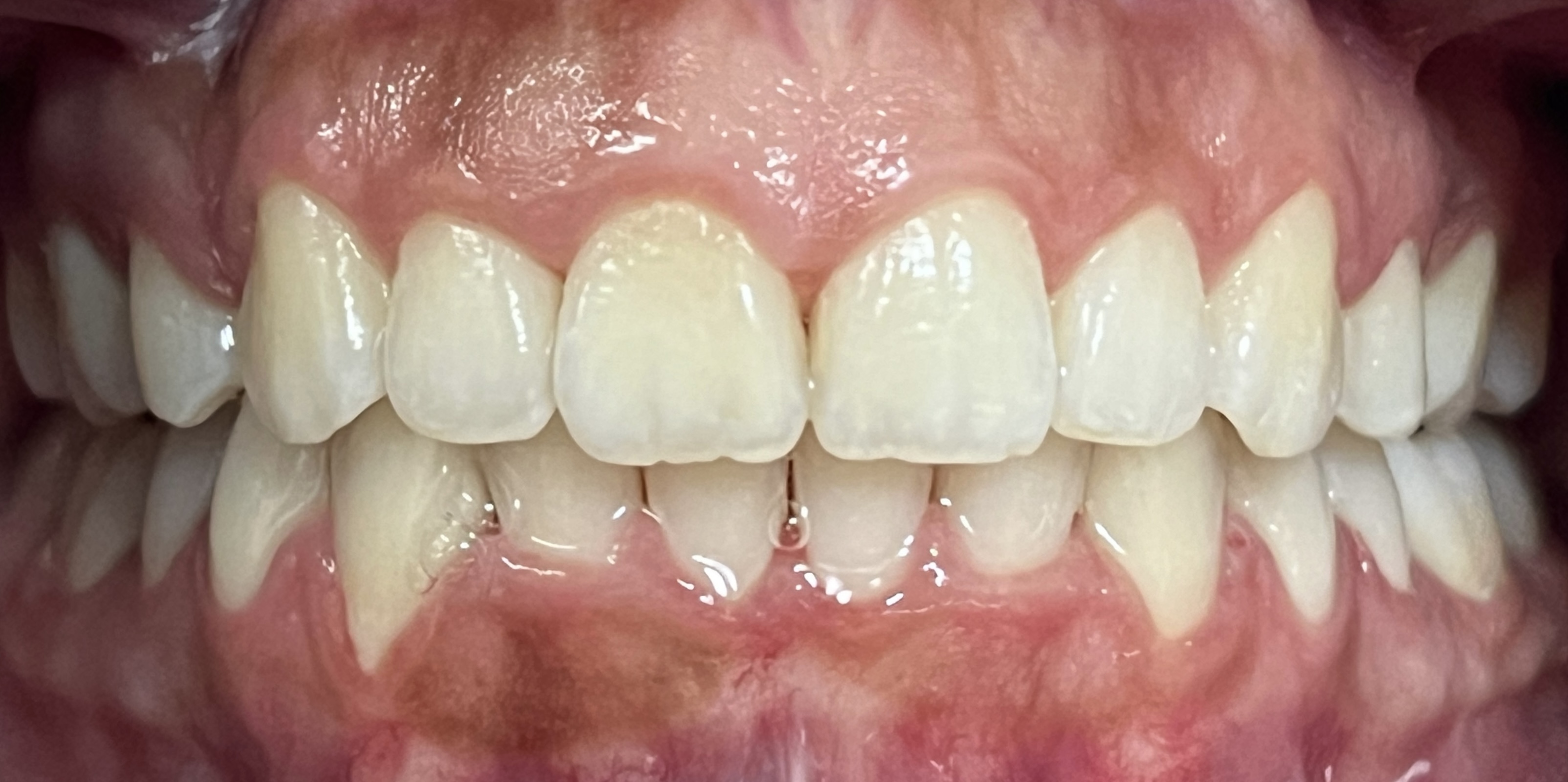 Close-up of Jennifer's teeth after Invisalign