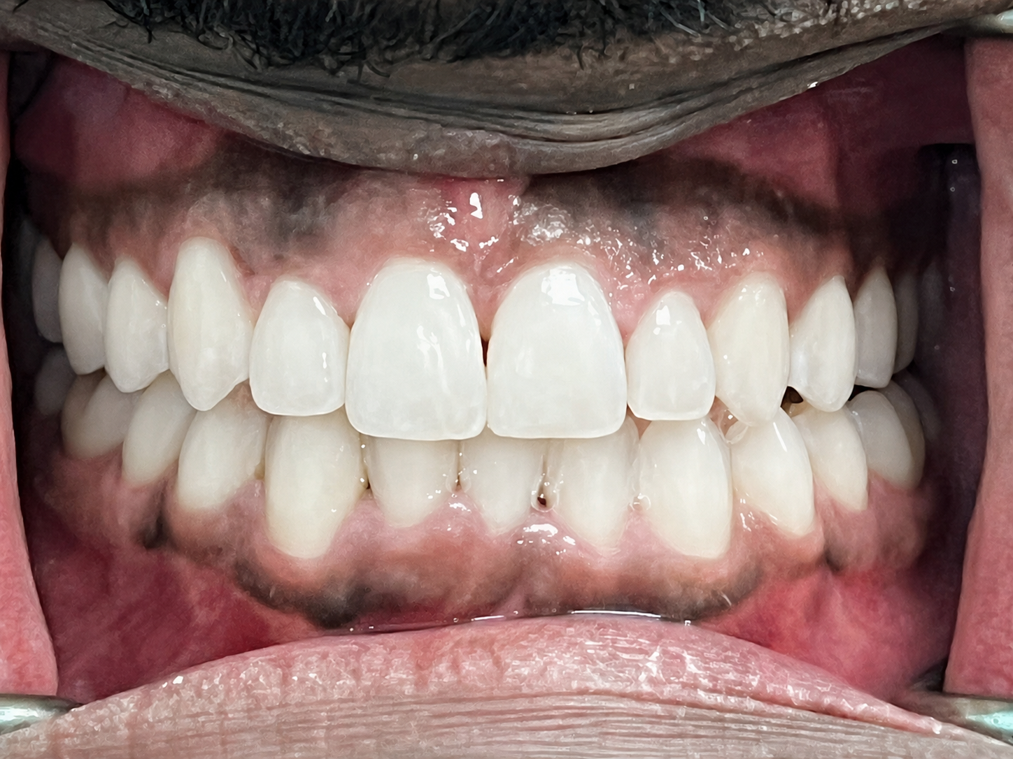 Close-up of Kent's teeth after Invisalign