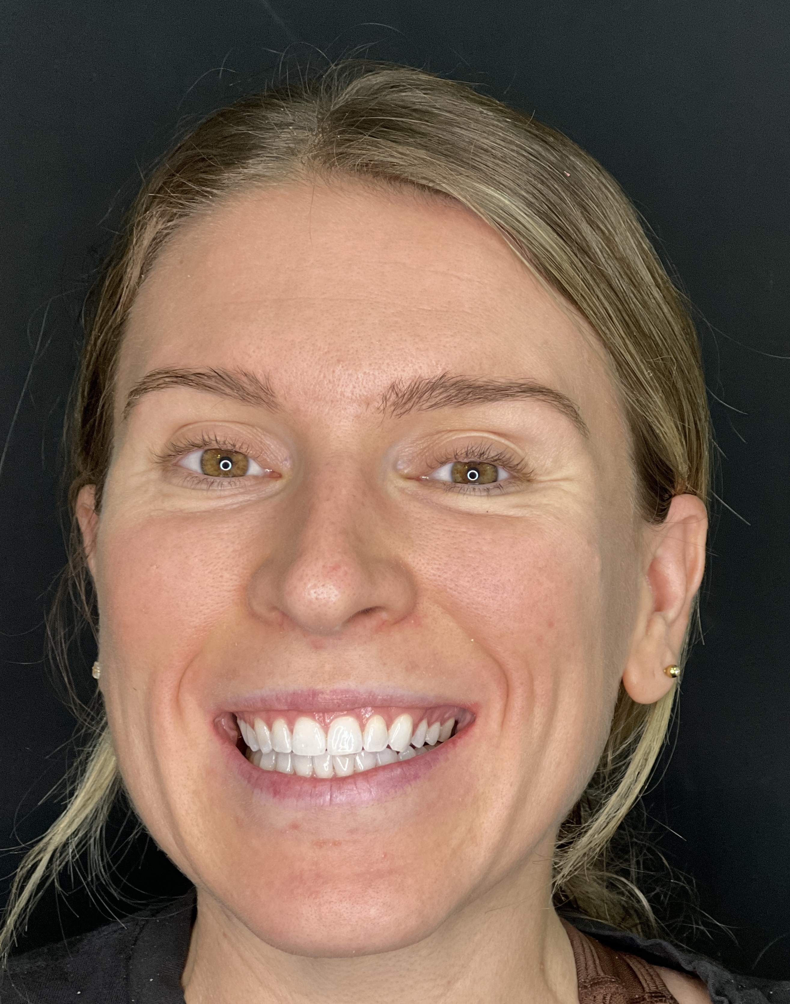 Mallory smiling after Invisalign treatment