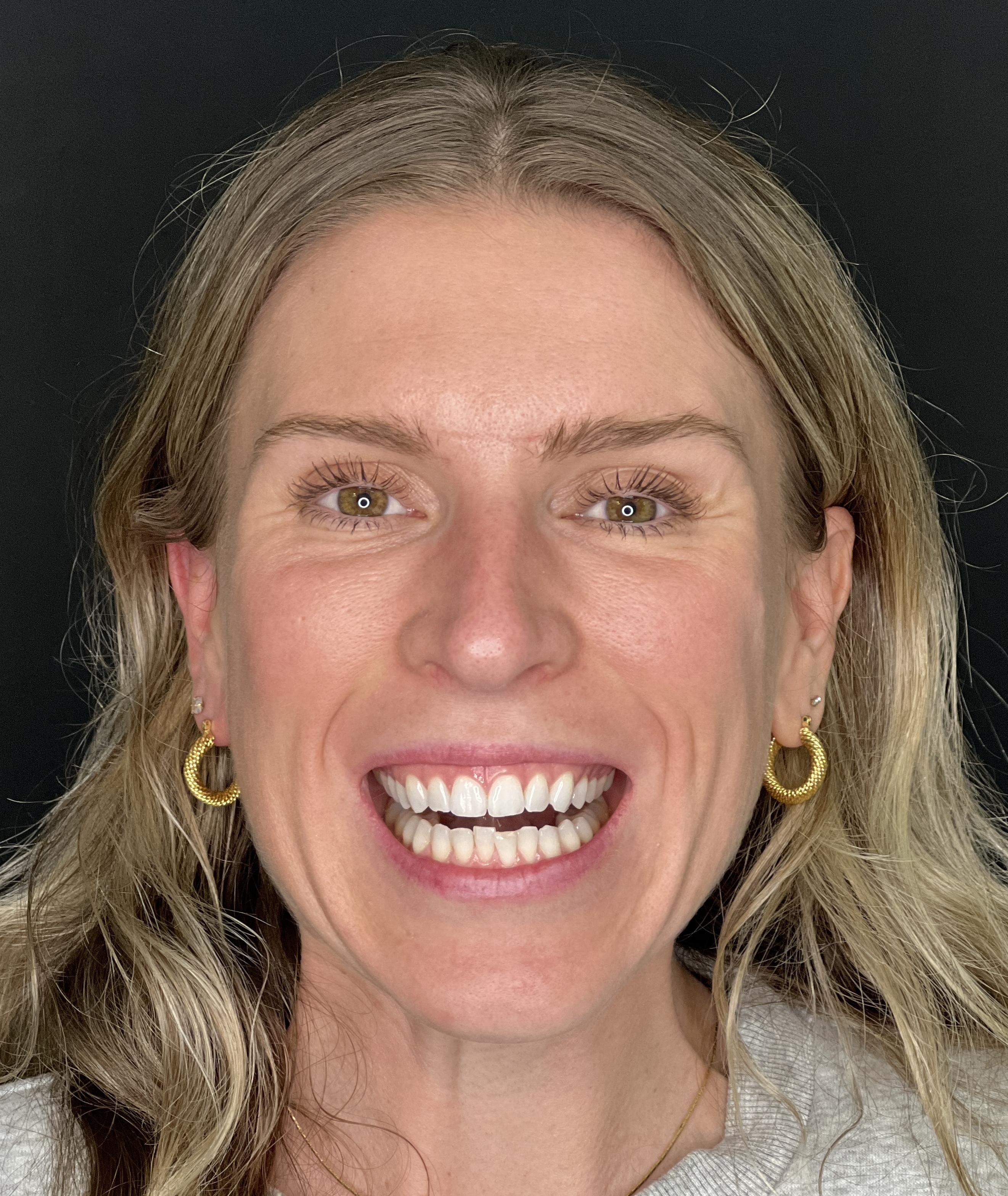 Mallory smiling before Invisalign treatment